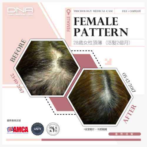 拔毛症導致頭皮嚴重發炎險壞死 2個月療程重塑頭皮環境