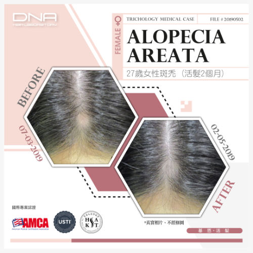 27歲女生頭頂髮界斑禿，活髮2個月已見改善_2