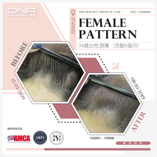 34歲女士打針減肥導致M額脫髮，活髮半年回復髮量_2