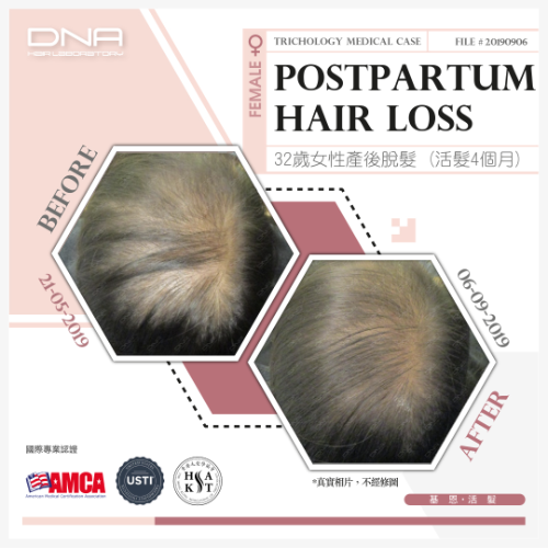 32歲新手媽媽產後脫髮，活髮4個月改善頭頂稀疏狀況_2