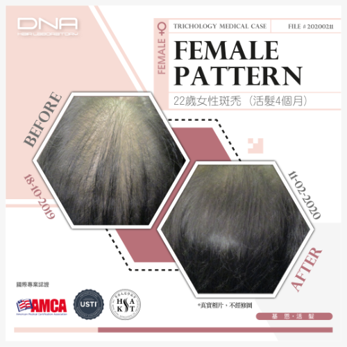 22歲女嚴重脫髮顯老30年,4個月治療回復80%髮量