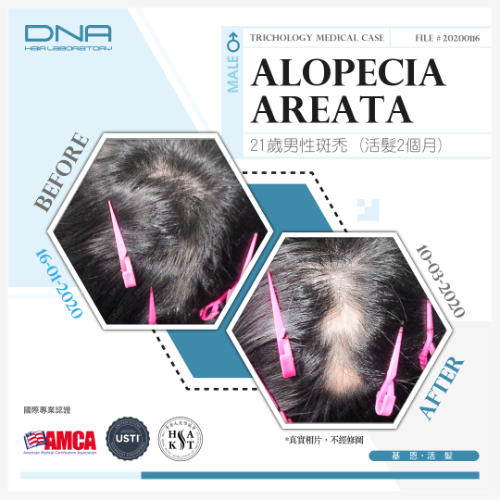 鬼剃頭會自然好?小心處理不當致惡化 2個月療程極速恢復