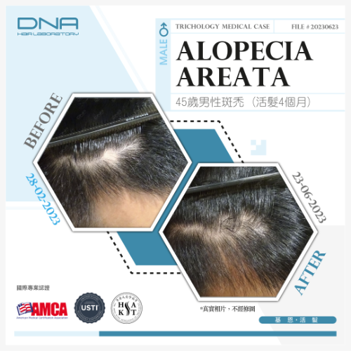 45歲銀行經理，壓力性斑禿脫髮，4個月治療後回復頭髮生長_2