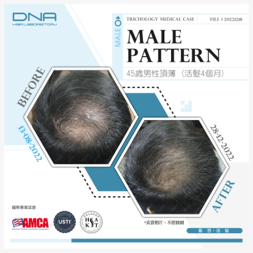 金融行業壓力大頭頂漸顯肉色 4個月療程頭髮逐漸恢復健康