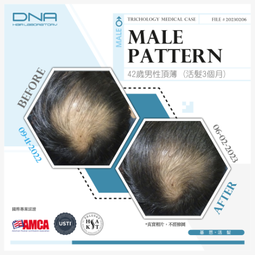 42歲男醫院助理，長期睡眠不足頂薄脫髮，活髮3個月改善地中海頂薄_2