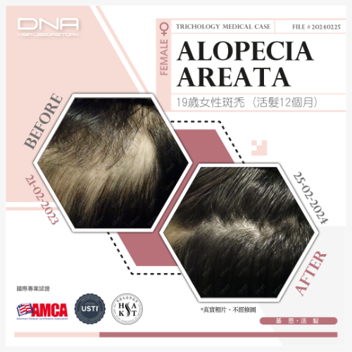 19歲女生讀書壓力頭頂斑禿,活髮12個月痊愈