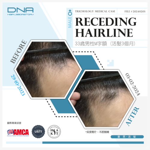 遺傳性脫髮並非無法治療，33歲男遺傳M字額，及早發現3個月修復髮際線_2