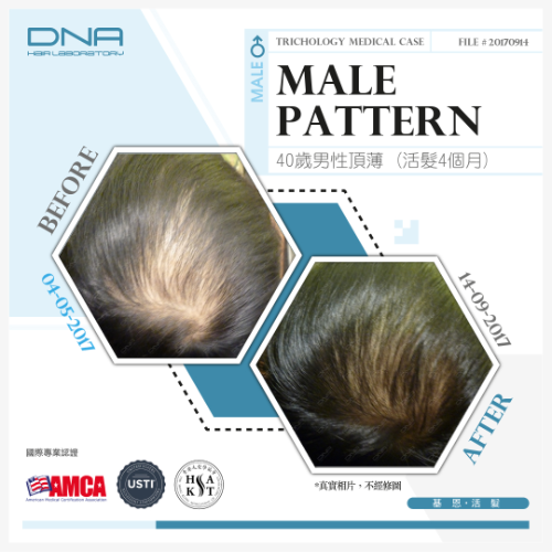 34歲男忽視頭油引致脂溢性脫髮,4個月療程改善頭頂髮量