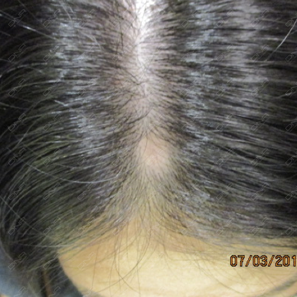 1196_Female_27_before