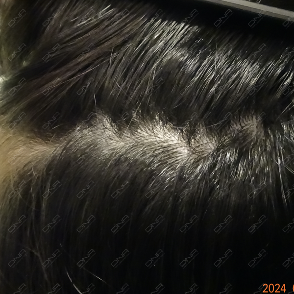 4687_Female_19_after