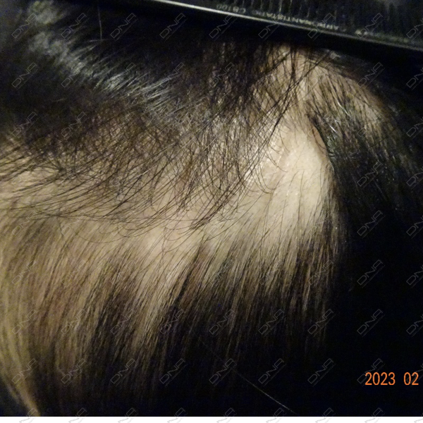 4687_Female_19_before